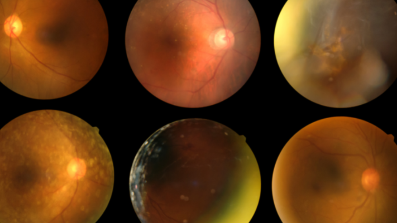 optica-lopsy-retinopatía-diabética